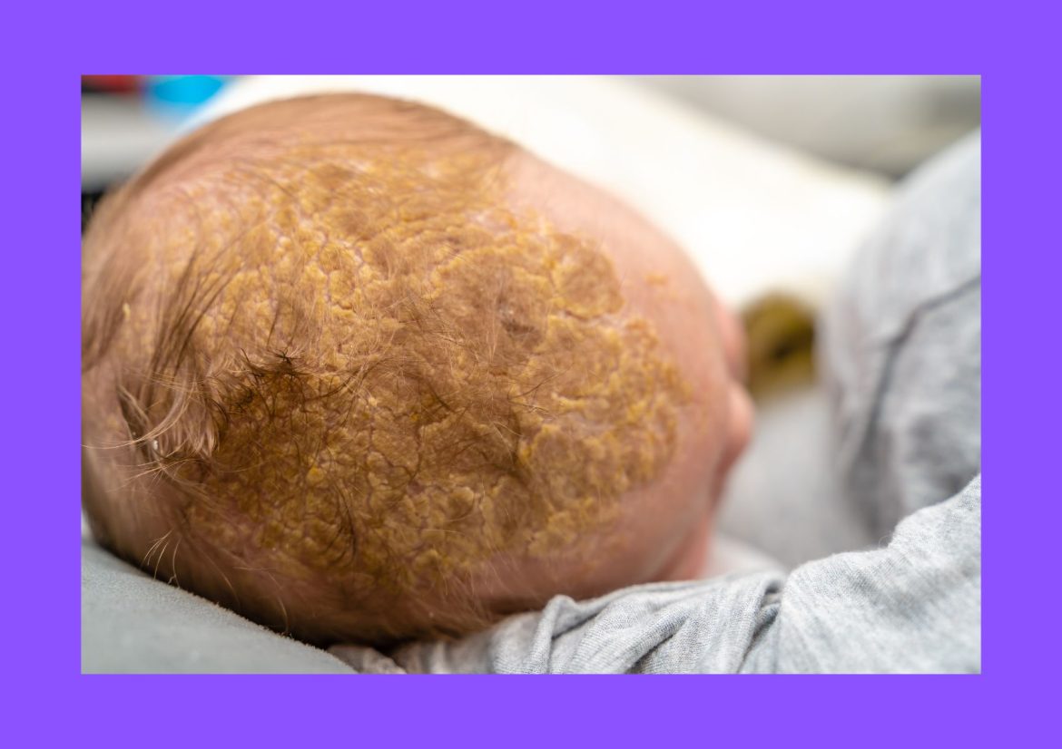 how to get rid of cradle cap fast